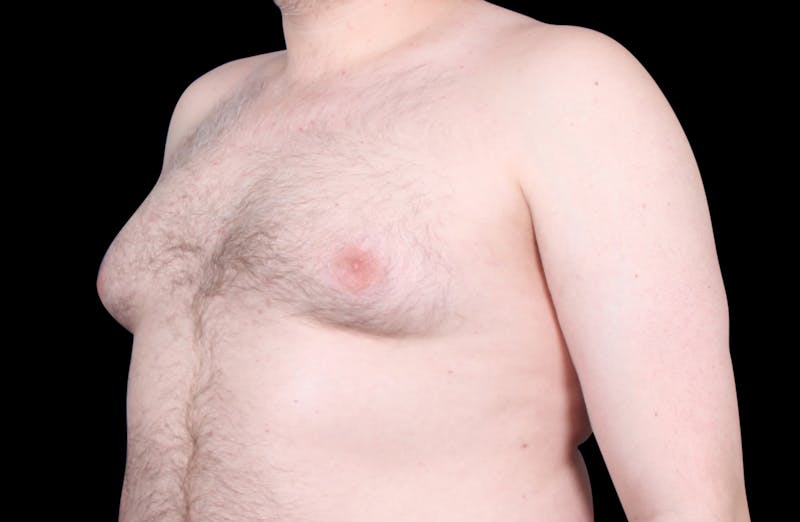 Gynecomastia Before & After Gallery - Patient 455649 - Image 7