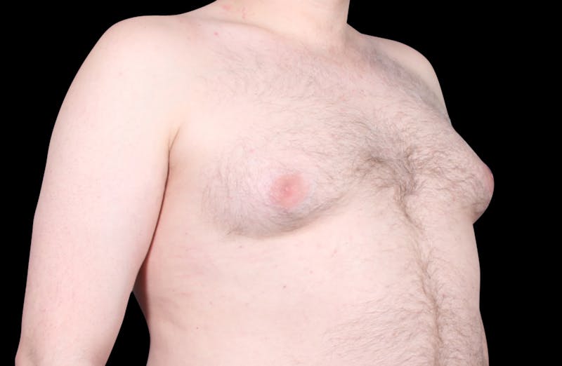 Gynecomastia Before & After Gallery - Patient 455649 - Image 3