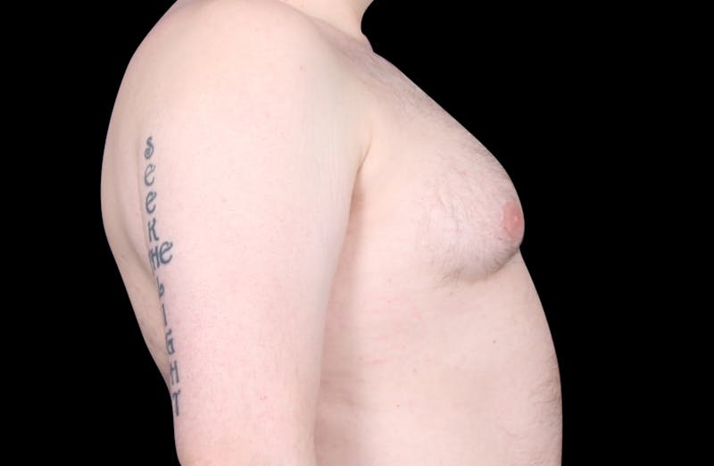 Gynecomastia Before & After Gallery - Patient 455649 - Image 5