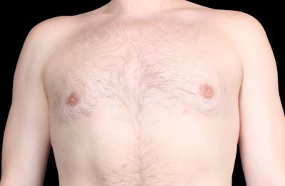 Gynecomastia Before & After Gallery - Patient 455649 - Image 2