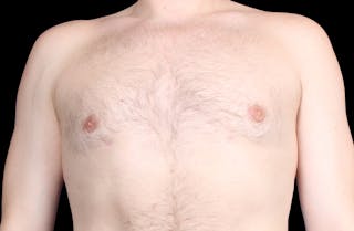 Gynecomastia Before & After Gallery - Patient 455649 - Image 2