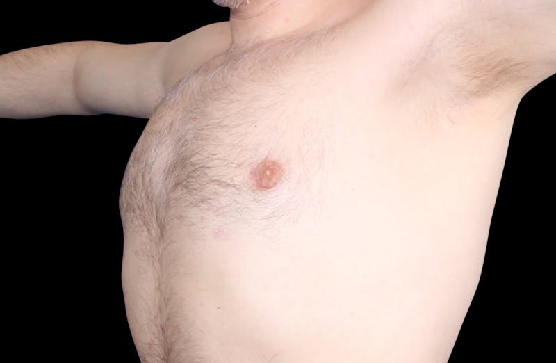 Gynecomastia Before & After Gallery - Patient 455649 - Image 8