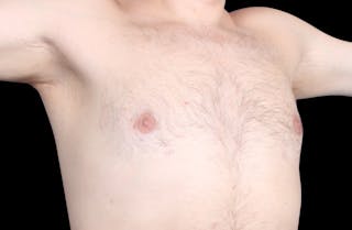 Gynecomastia Before & After Gallery - Patient 455649 - Image 4