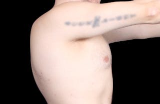 Gynecomastia Before & After Gallery - Patient 455649 - Image 6