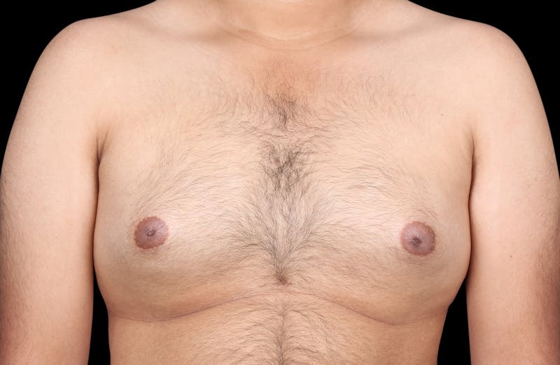 Gynecomastia Before & After Gallery - Patient 230654 - Image 1