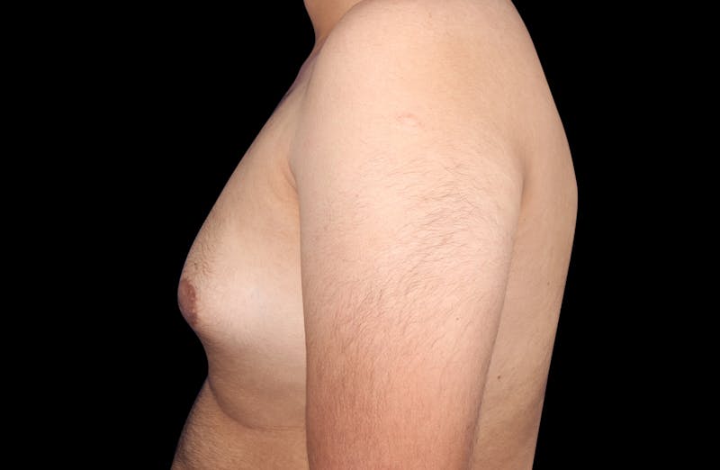 Gynecomastia Before & After Gallery - Patient 230654 - Image 9
