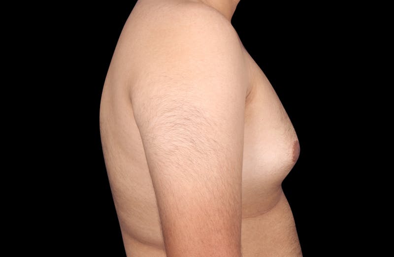 Gynecomastia Before & After Gallery - Patient 230654 - Image 5