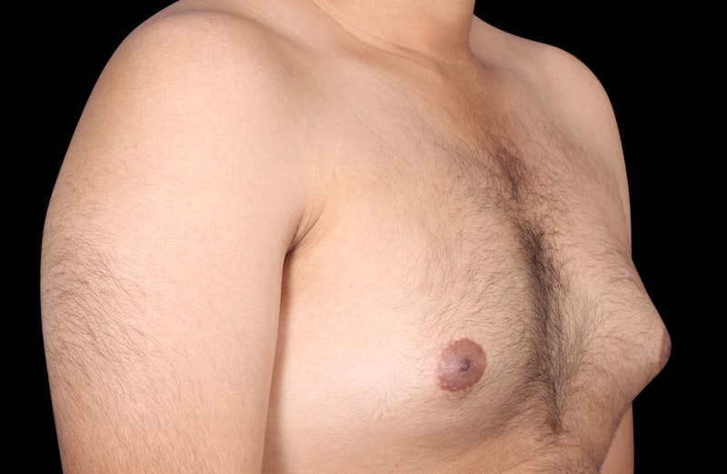 Gynecomastia Before & After Gallery - Patient 230654 - Image 3