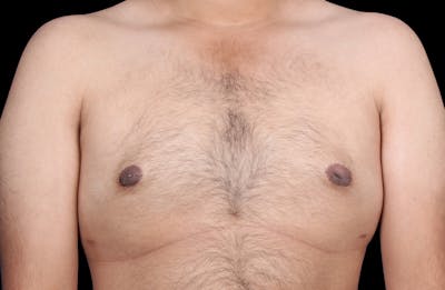 Gynecomastia Before & After Gallery - Patient 230654 - Image 2