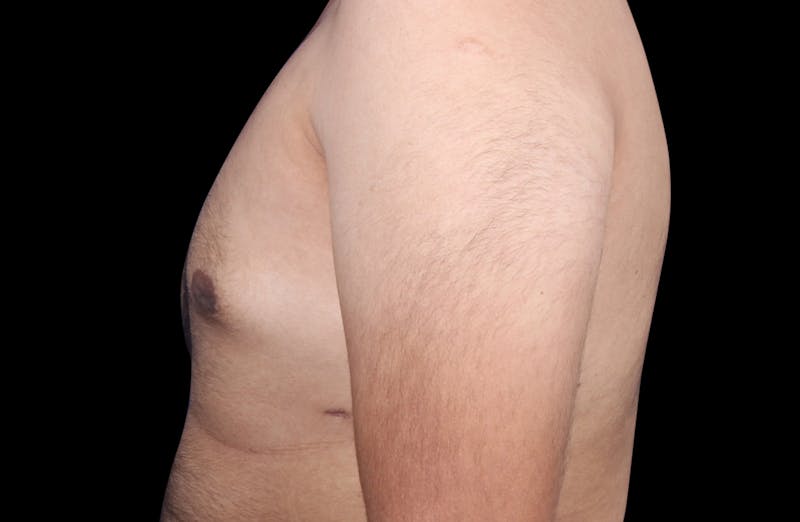 Gynecomastia Before & After Gallery - Patient 230654 - Image 10