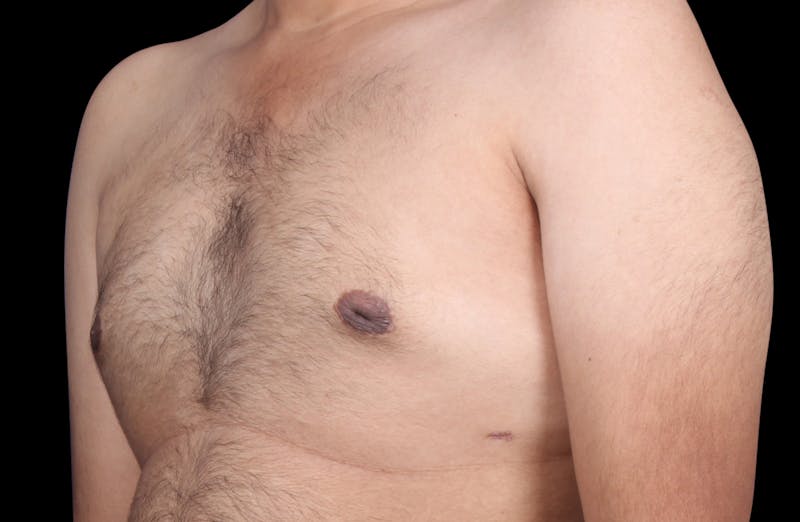 Gynecomastia Before & After Gallery - Patient 230654 - Image 8