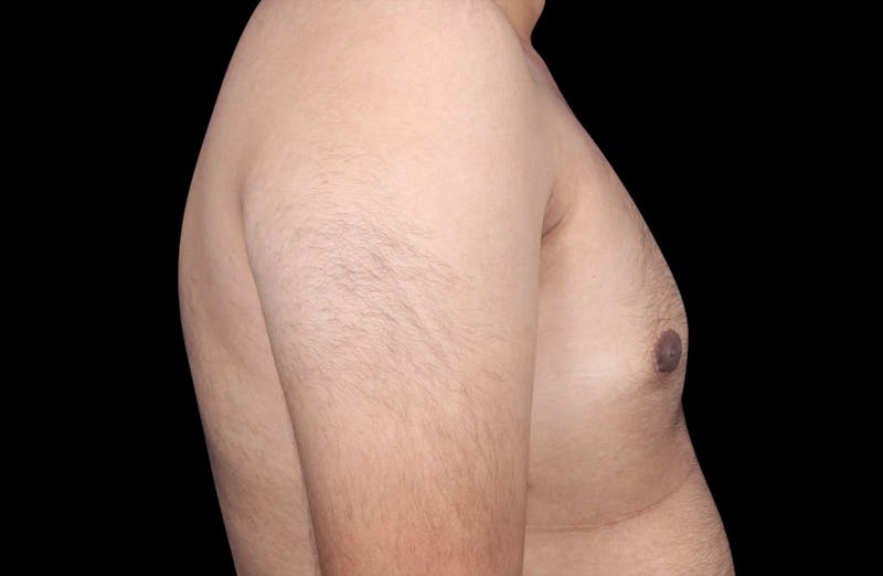 Gynecomastia Before & After Gallery - Patient 230654 - Image 6