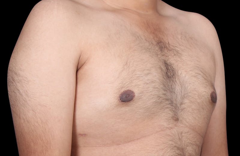 Gynecomastia Before & After Gallery - Patient 230654 - Image 4