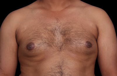Gynecomastia Before & After Gallery - Patient 381668 - Image 1
