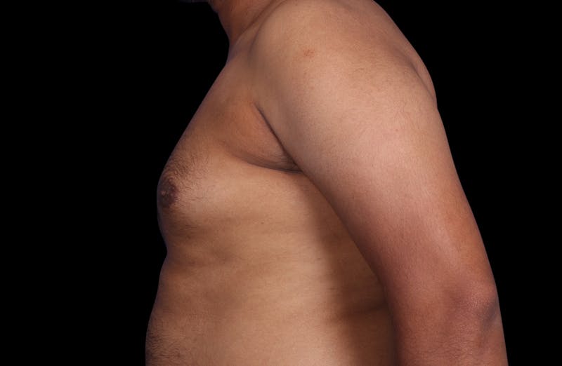 Gynecomastia Before & After Gallery - Patient 381668 - Image 9