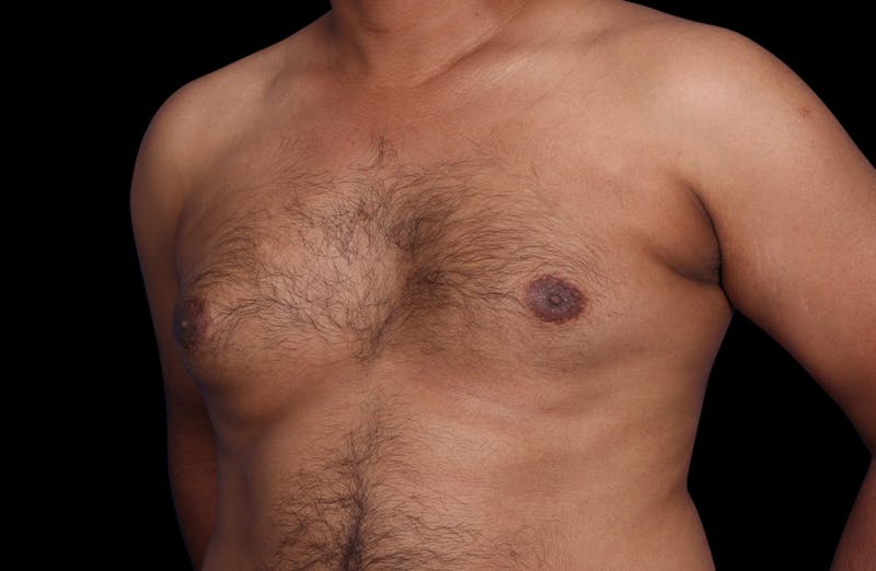 Gynecomastia Before & After Gallery - Patient 381668 - Image 7