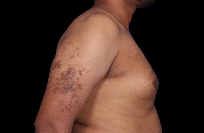 Gynecomastia Before & After Gallery - Patient 381668 - Image 5