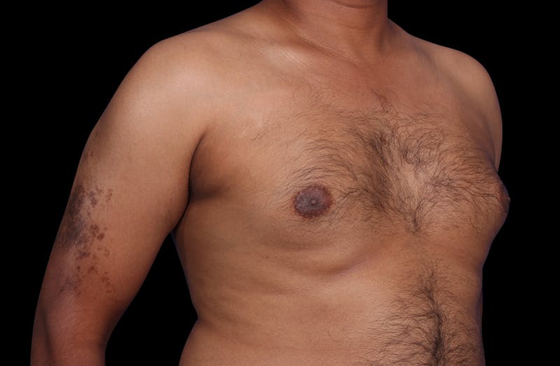 Gynecomastia Before & After Gallery - Patient 381668 - Image 3