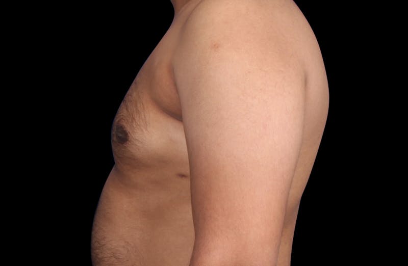 Gynecomastia Before & After Gallery - Patient 381668 - Image 10