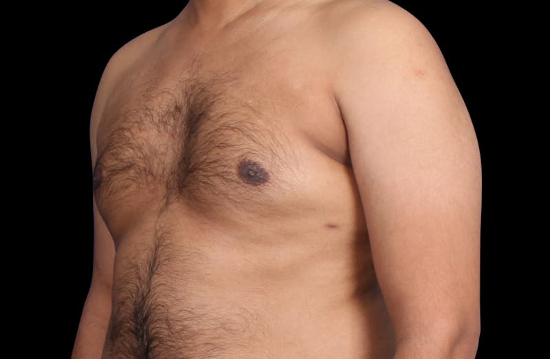 Gynecomastia Before & After Gallery - Patient 381668 - Image 8