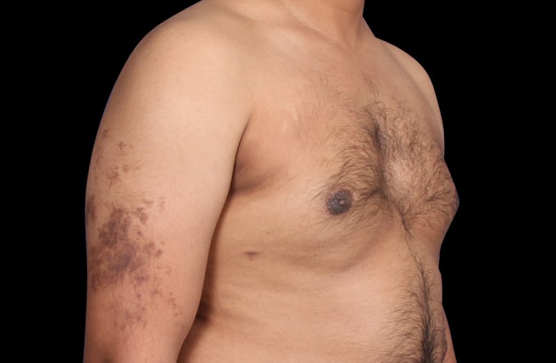 Gynecomastia Before & After Gallery - Patient 381668 - Image 4