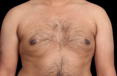 Gynecomastia Before & After Gallery - Patient 381668 - Image 2