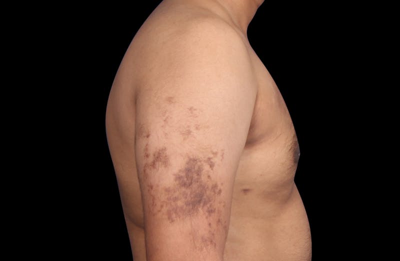 Gynecomastia Before & After Gallery - Patient 381668 - Image 6