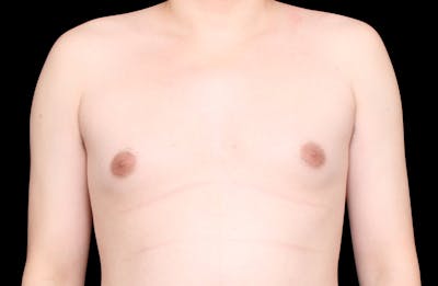 Gynecomastia Before & After Gallery - Patient 101174 - Image 1
