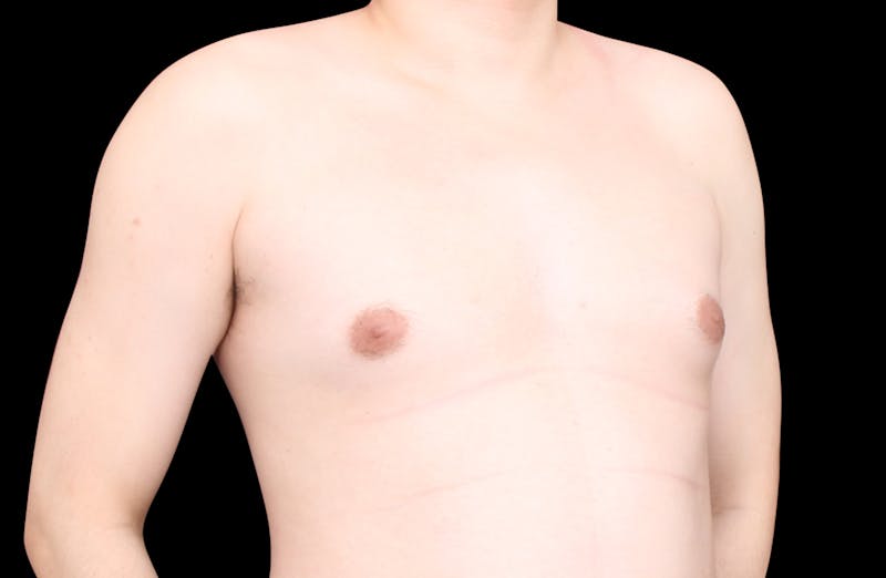 Gynecomastia Before & After Gallery - Patient 101174 - Image 3