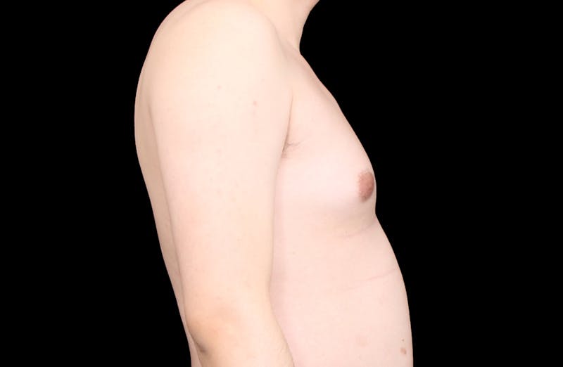 Gynecomastia Before & After Gallery - Patient 101174 - Image 5