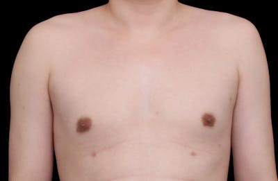 Gynecomastia Before & After Gallery - Patient 101174 - Image 2