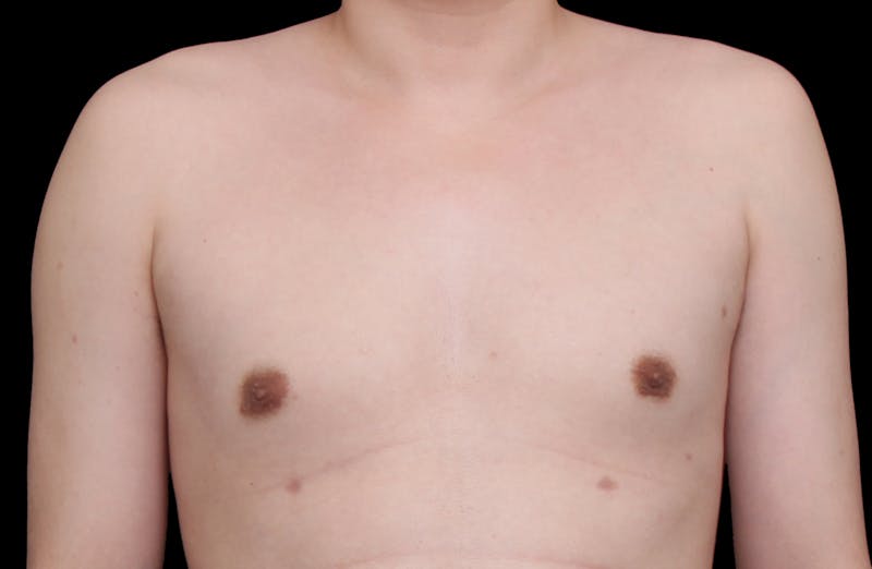 Gynecomastia Before & After Gallery - Patient 101174 - Image 2