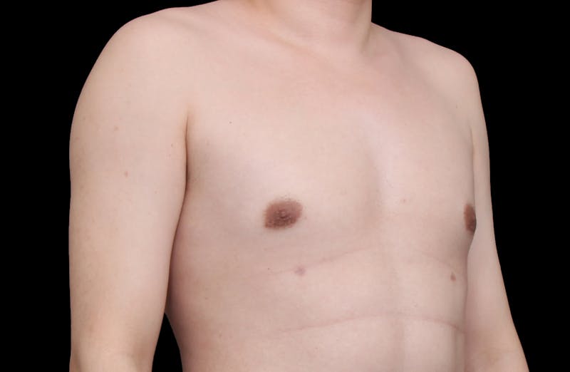 Gynecomastia Before & After Gallery - Patient 101174 - Image 4