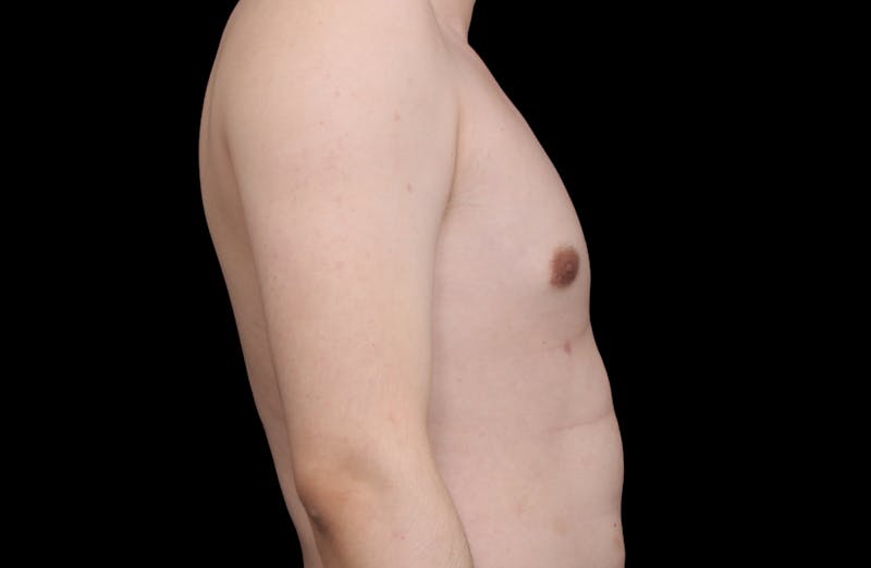 Gynecomastia Before & After Gallery - Patient 101174 - Image 6