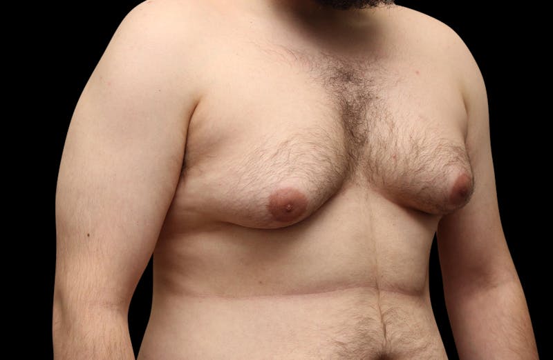 Gynecomastia Before & After Gallery - Patient 203420 - Image 3