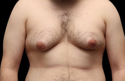 Gynecomastia Before & After Gallery - Patient 203420 - Image 1