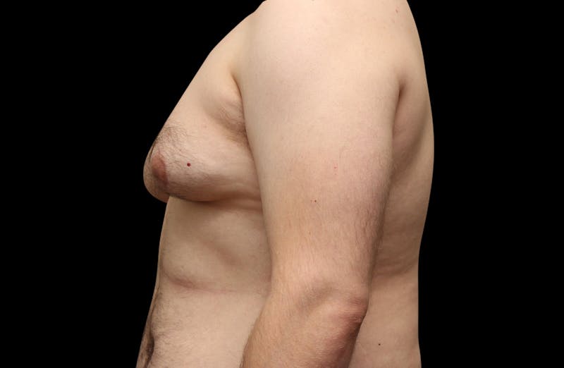 Gynecomastia Before & After Gallery - Patient 203420 - Image 9