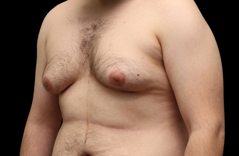 Gynecomastia Before & After Gallery - Patient 203420 - Image 7