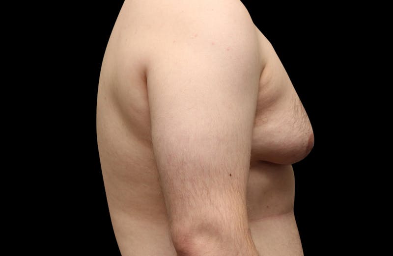 Gynecomastia Before & After Gallery - Patient 203420 - Image 5