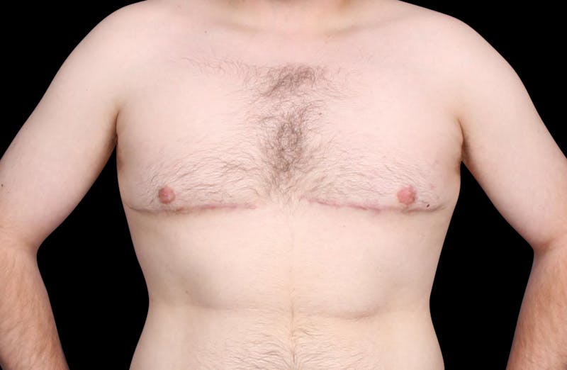 Gynecomastia Before & After Gallery - Patient 203420 - Image 2