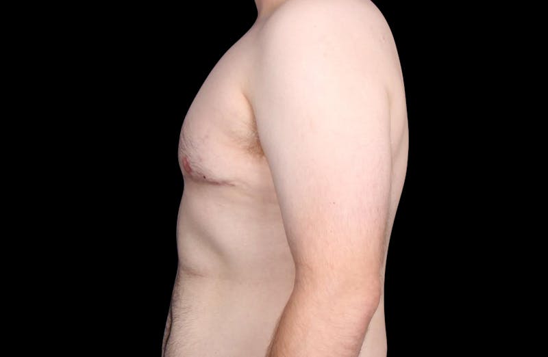 Gynecomastia Before & After Gallery - Patient 203420 - Image 10