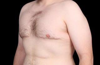 Gynecomastia Before & After Gallery - Patient 203420 - Image 8