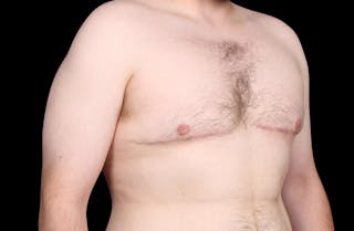 Gynecomastia Before & After Gallery - Patient 203420 - Image 4