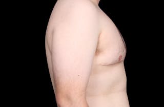 Gynecomastia Before & After Gallery - Patient 203420 - Image 6