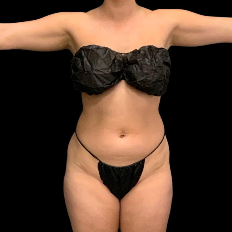 Hi Def Lipo Before & After Gallery - Patient 633553 - Image 1