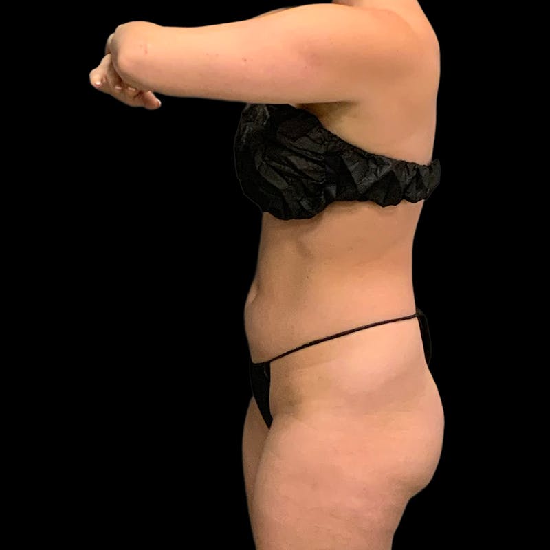 Hi Def Lipo Before & After Gallery - Patient 633553 - Image 11