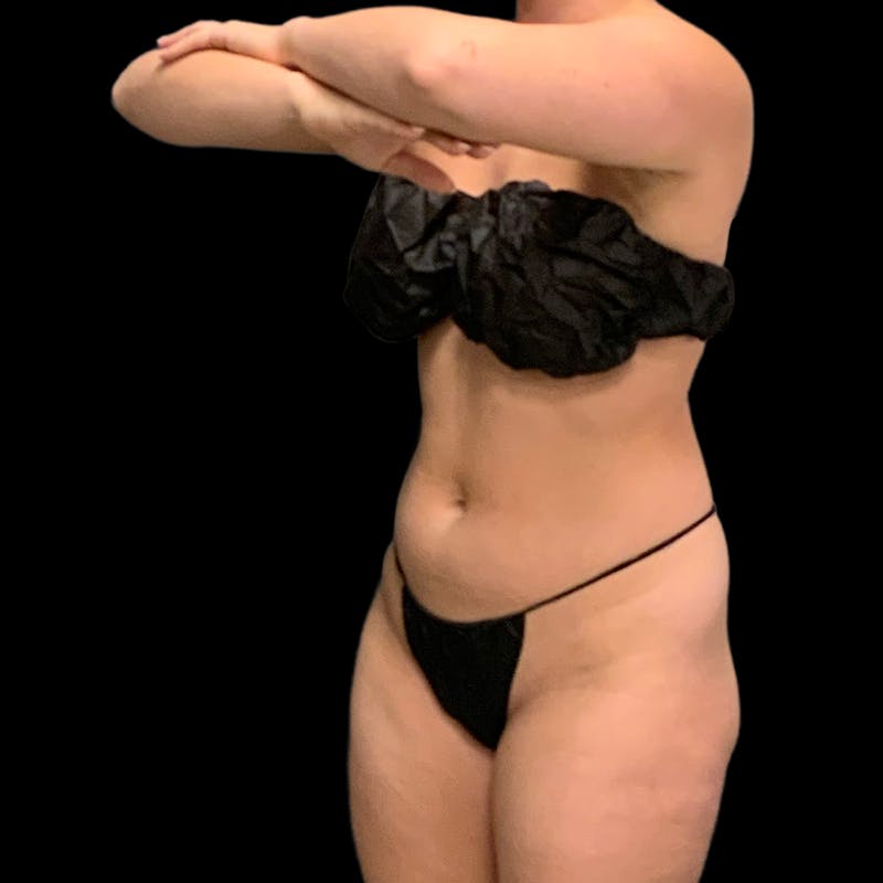 Hi Def Lipo Before & After Gallery - Patient 633553 - Image 9