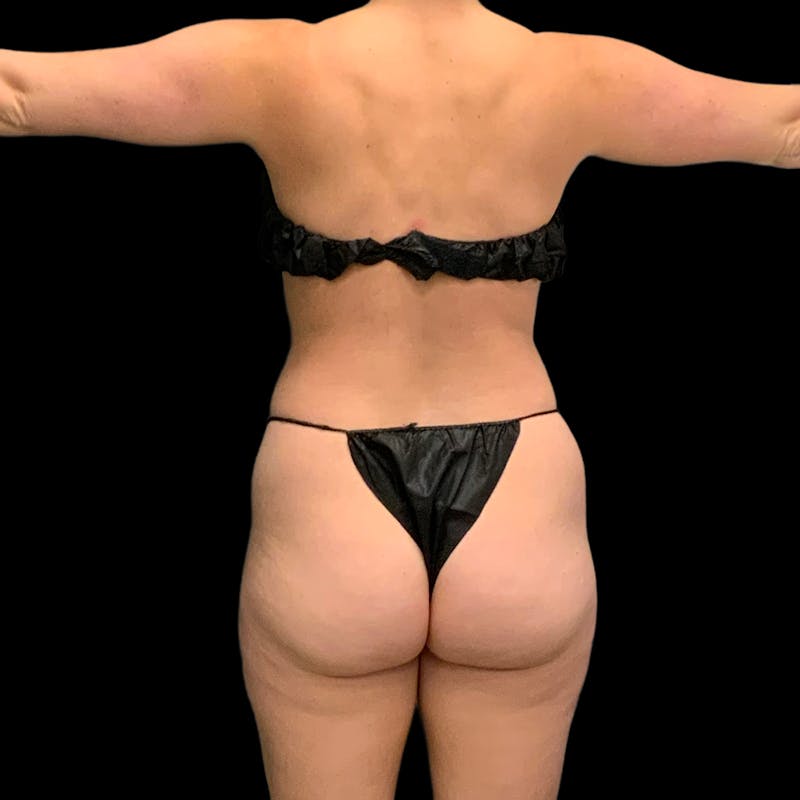 Hi Def Lipo Before & After Gallery - Patient 633553 - Image 7