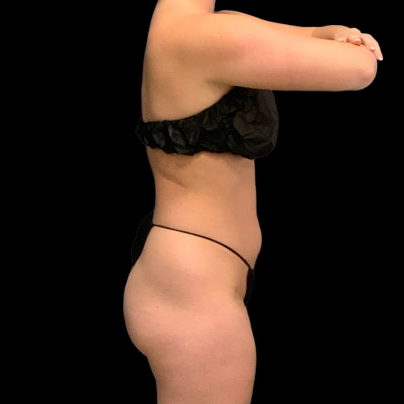 Hi Def Lipo Before & After Gallery - Patient 633553 - Image 5