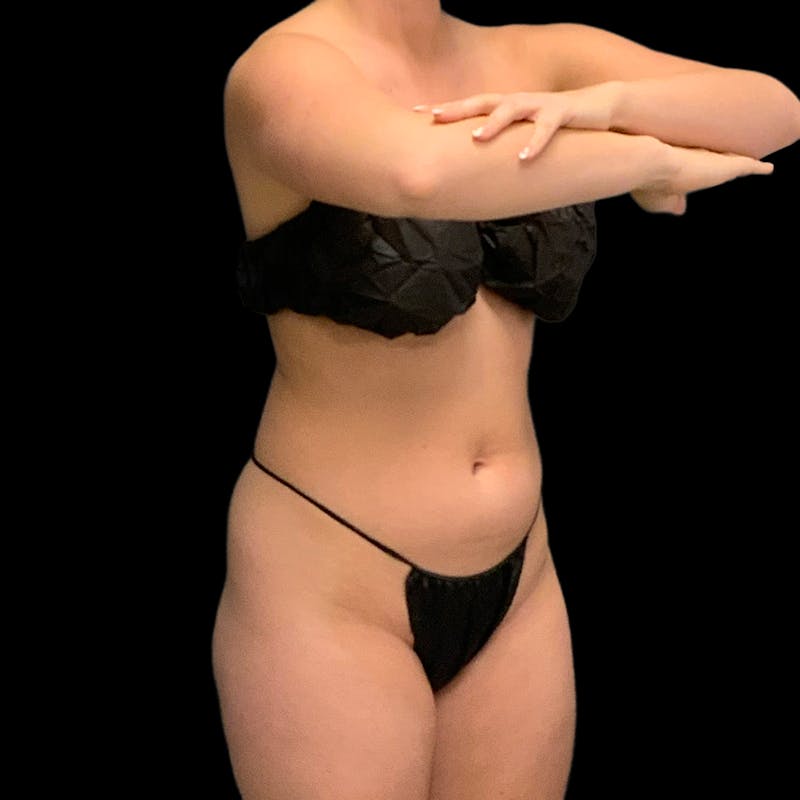 Hi Def Lipo Before & After Gallery - Patient 633553 - Image 3